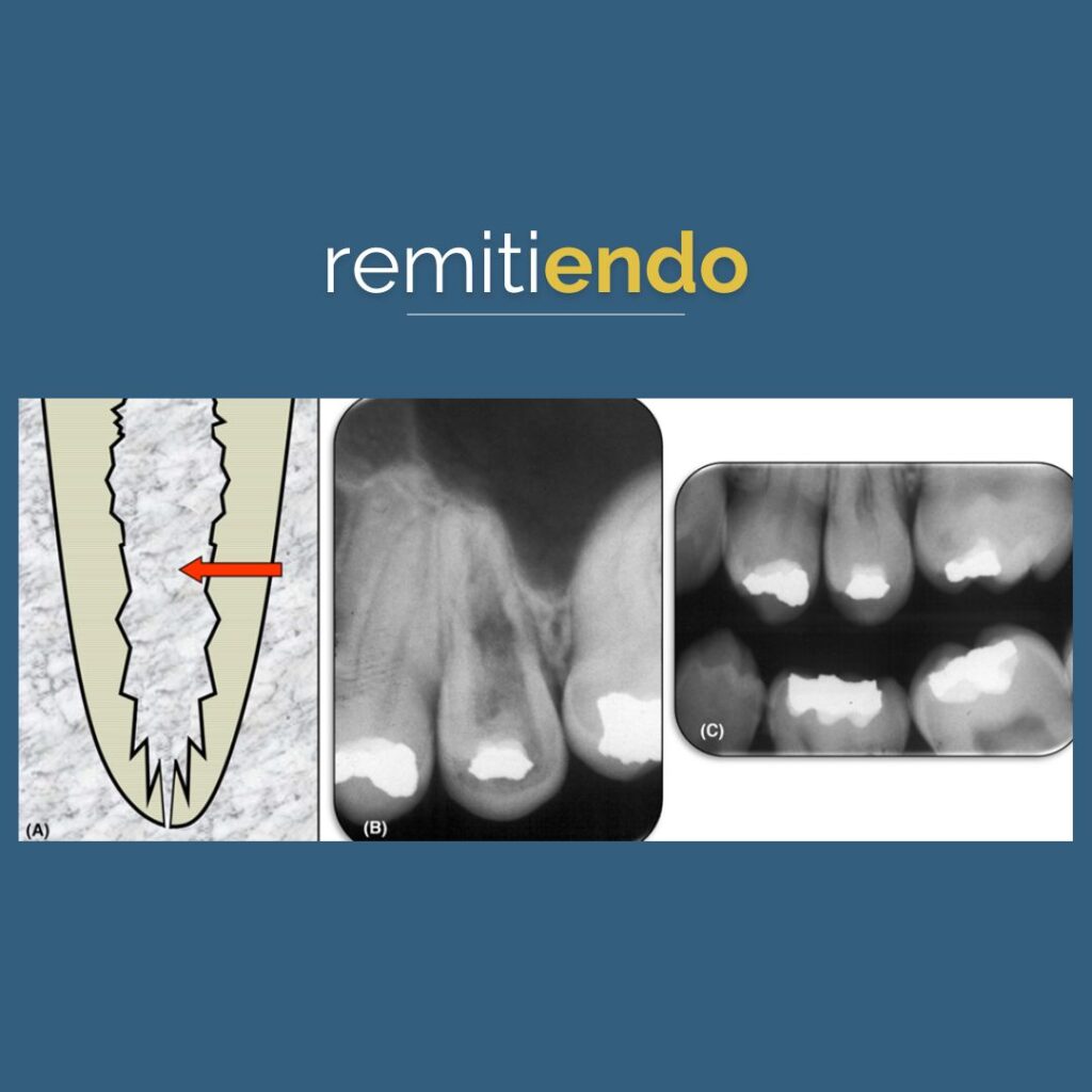 Hablemos De Reabsorciones Reabsorci N Interna