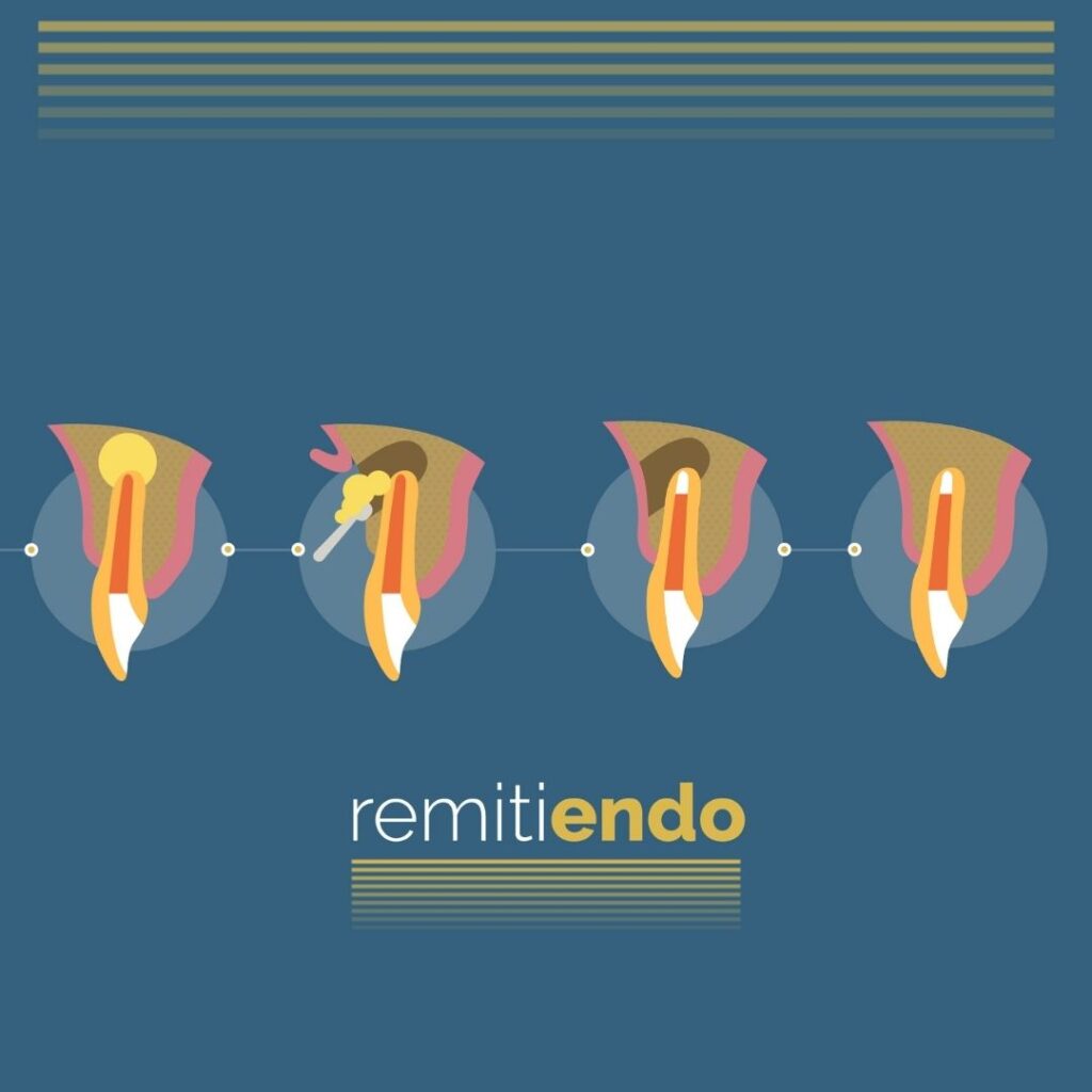 Microcirugia endodontica apical Marion Ormeno