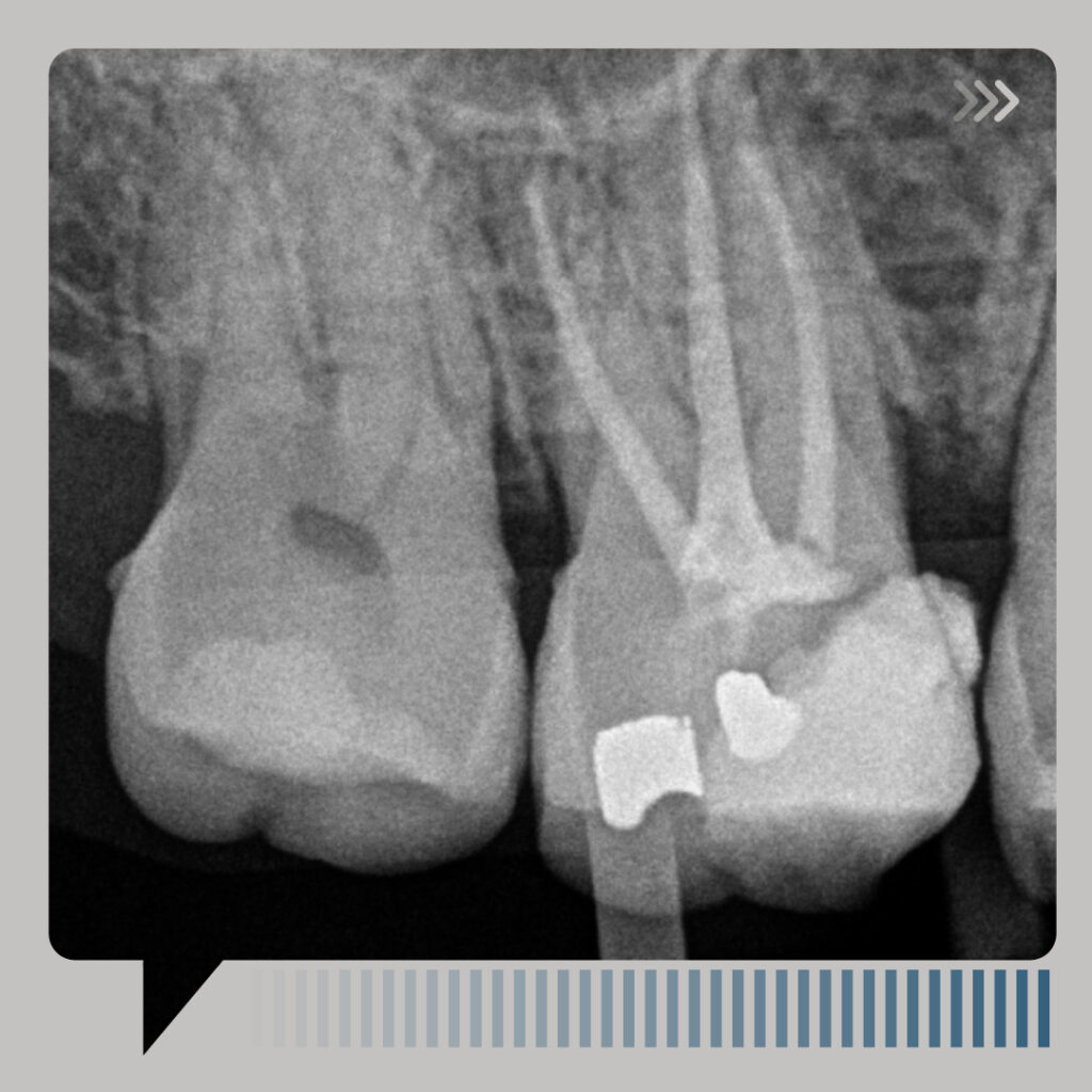 Obturación en endodoncia