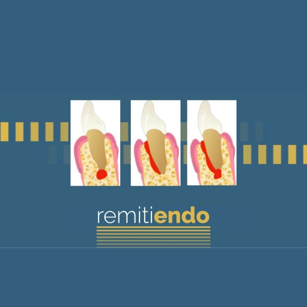 Lesiones endo-periodontales: una visión endodóntica