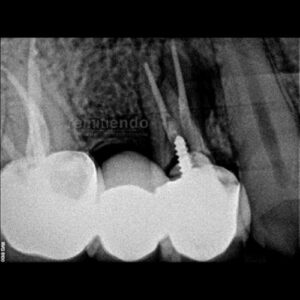 caso endodoncia remitiendo 4 marion ormeno