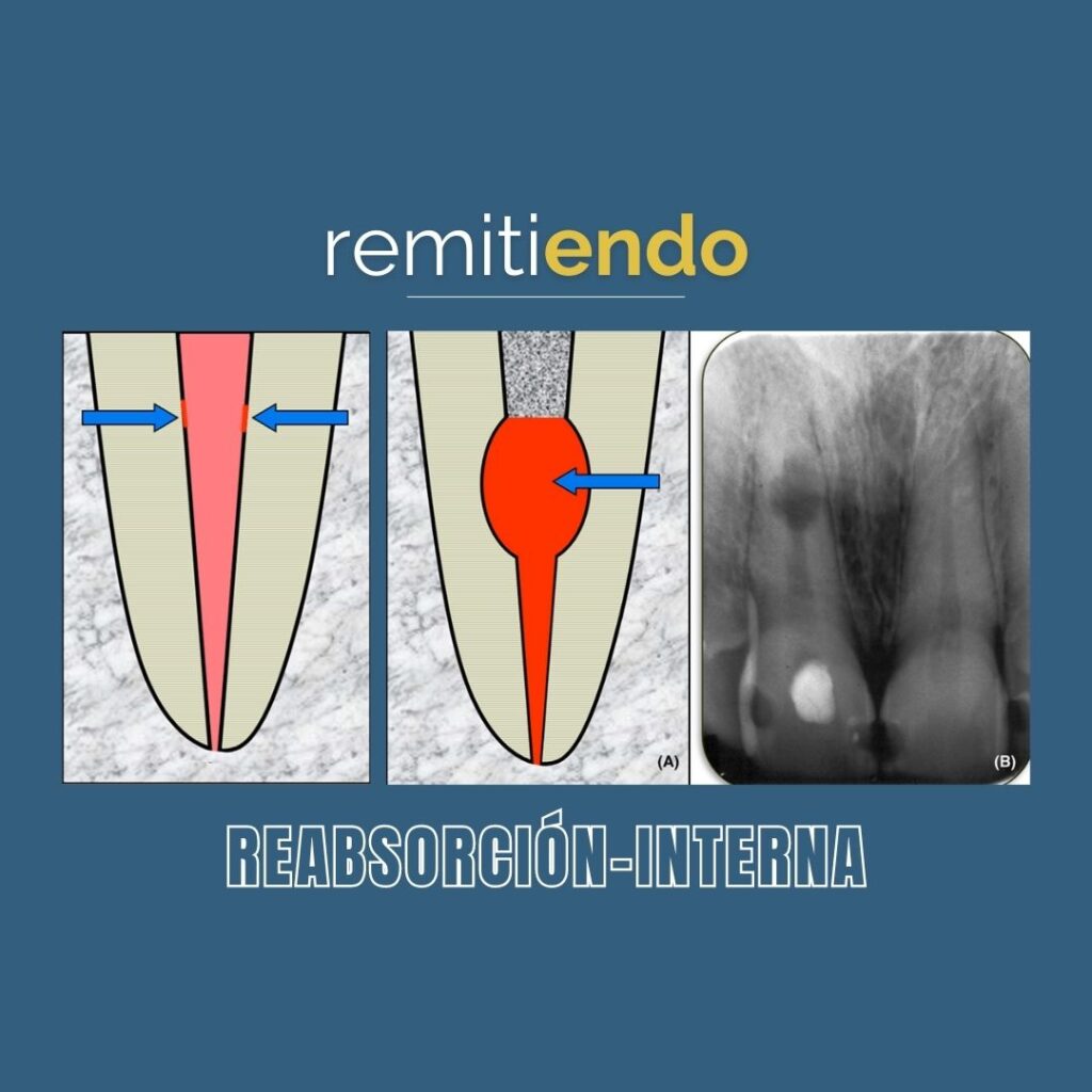 Reabsorción Interna Endodoncia México Remitiendo