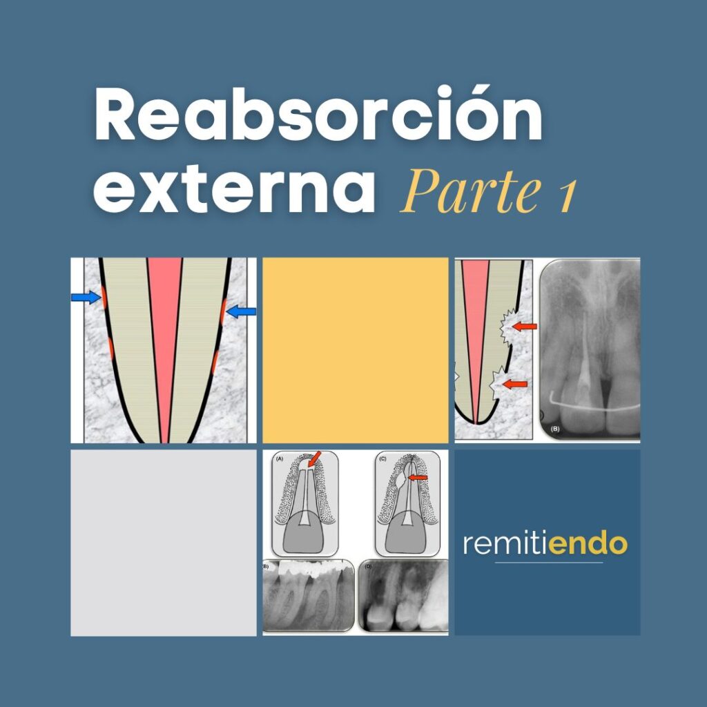 Reabsorción externa endodoncia México