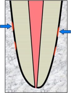 Reabsorción de la superficie externa