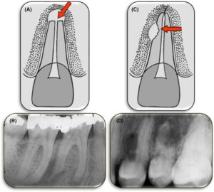 Reabsorción inflamatoria externa