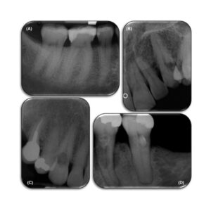 Reabsorción invasiva externa radiografía