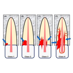 Reabsorción invasiva externa