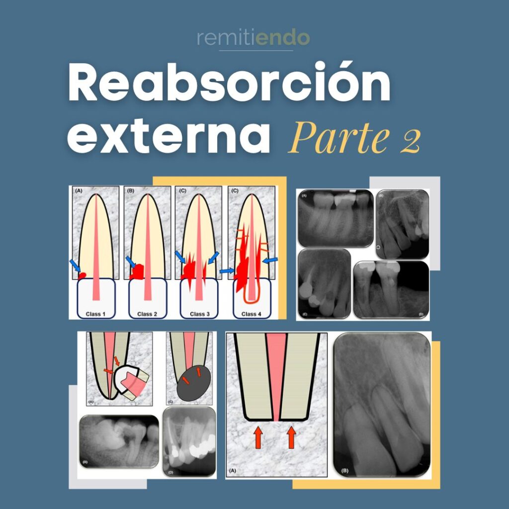 Reabsorción Externa Endodoncia