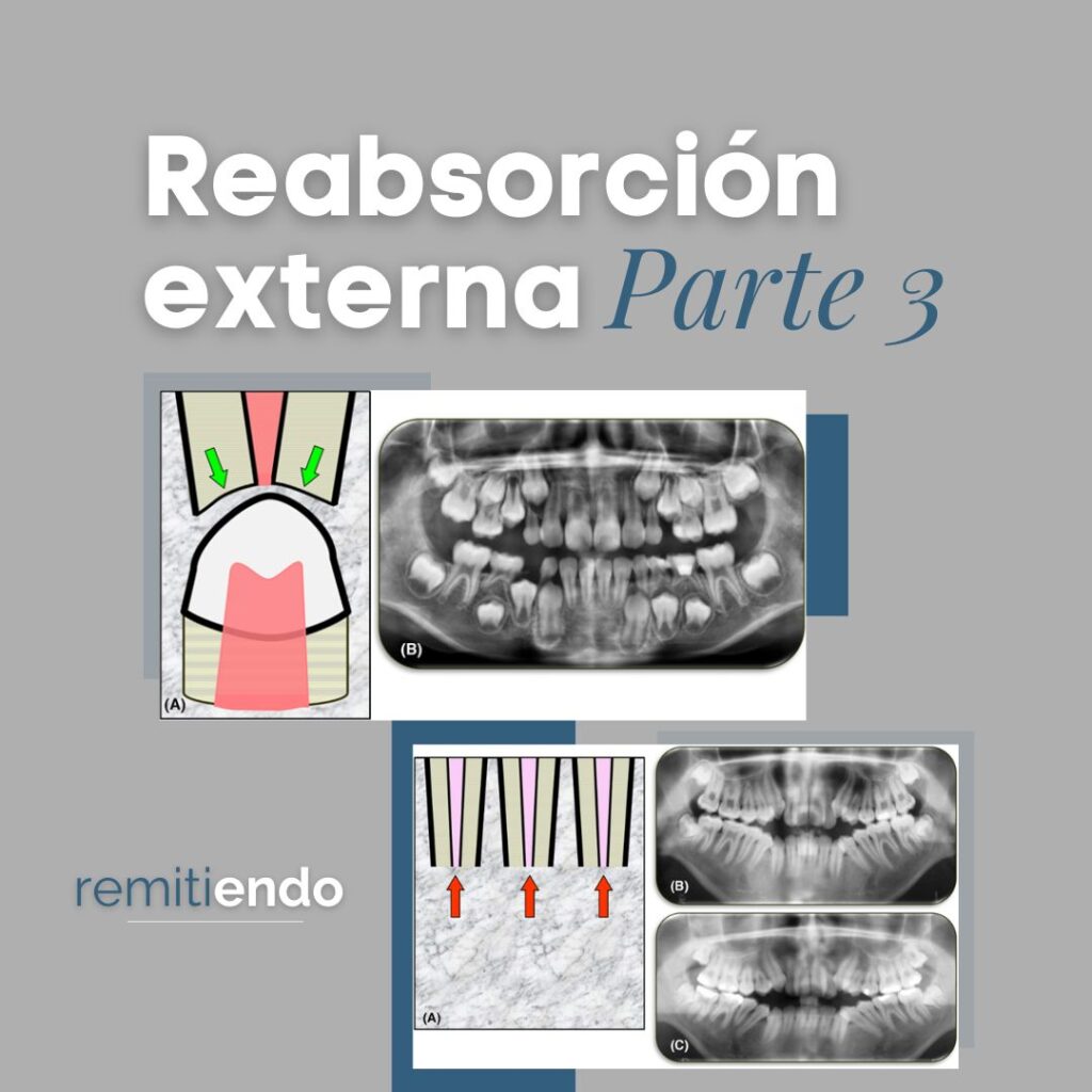 reabsorcion-externa-parte-III